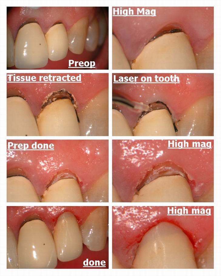 Resize of Class V decay under crown.jpg